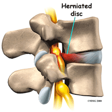 Herniated Disc  Becker Spine and Sports Institute, LLC
